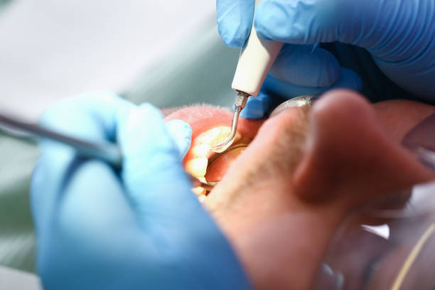 Best Emergency Wisdom Teeth Removal in Shoreacres, TX